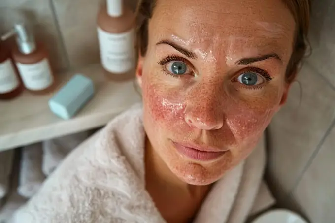 Quelle crème est la plus efficace pour soulager la couperose ? découvrez notre sélection optimisée !